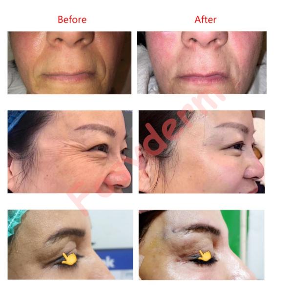 кожа подъема потока 26G 27G медицинская Mono PDO затягивая губы подъема потока PDO