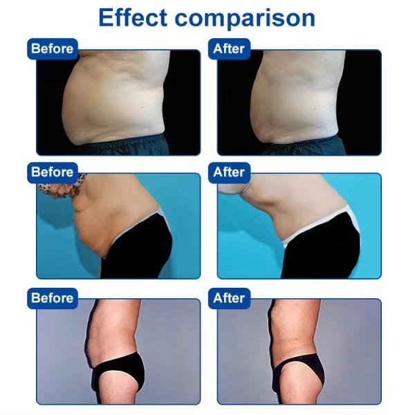 Бесконтактная площадь тела Снижение жировых отложений Скульптура тела Устройства для похудения для домашнего использования и салона красоты