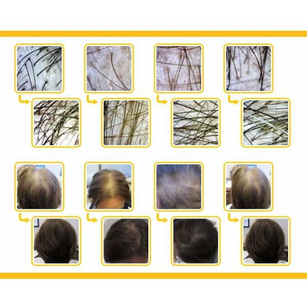 Шлем обработки Regrowth машины роста волос лазера СИД вертикальный фотодинамический
