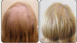 Professional 3 type LED combined 650nm 808nm diode laser hair regrowth machine