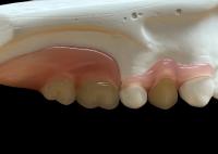 Dentadura flexível invisível ajustável: adequada para mastigar confortável e falar com durabilidade variável