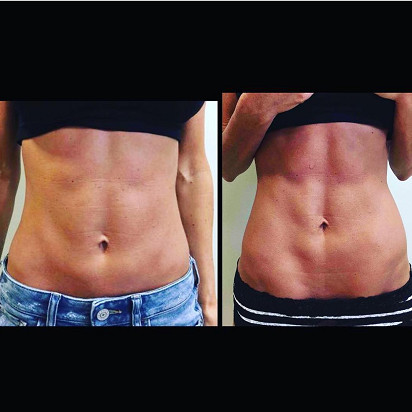 OEM 7 Tesla Pelvic Floor Muscle Strengthening Machine 2 Working Handles