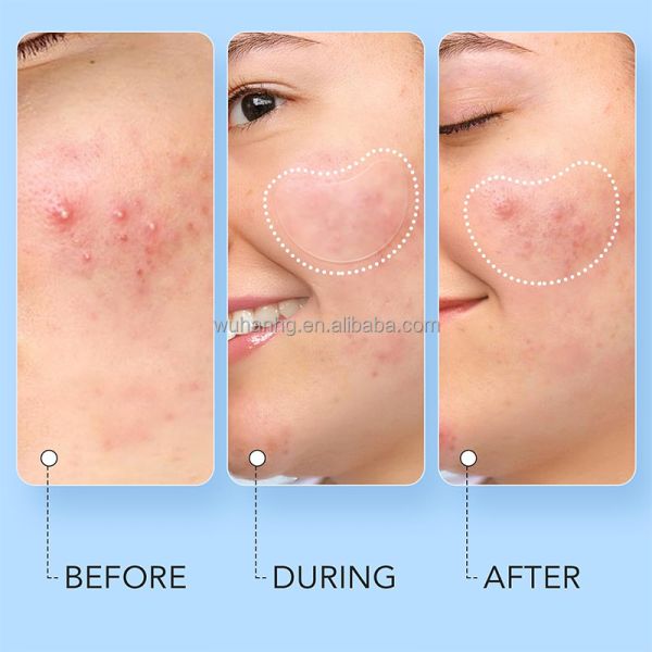 Varied Tones Hydrocolloid Pimple Patches For Acne Care Customized Size