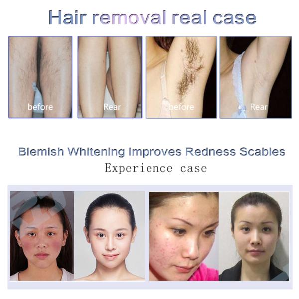 3000W IPL SHR Hair Removal Machine , Anti Aging Multifunctional Beauty Equipment