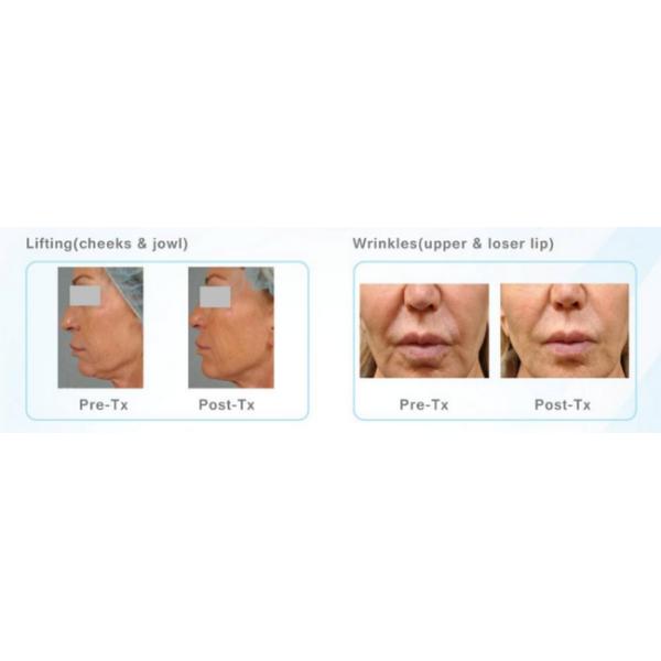 Professional HIFU Machine / Non Surgical Ultrasonic Face Lift Machine For Home