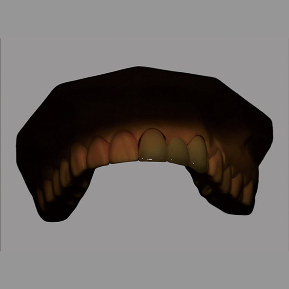 Puente PFZ de cerámica completa biocompatible con sistema CAD/CAM