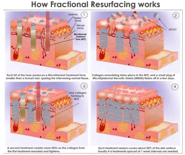 Continuous Fotona Fractional Co2 Laser Beauty Machine For Dark Circles