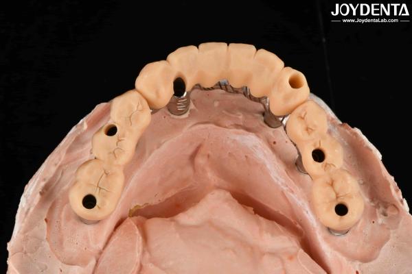 Yellow Resin Temporary Teeth Smooth Surface Treatment Precise And Stable