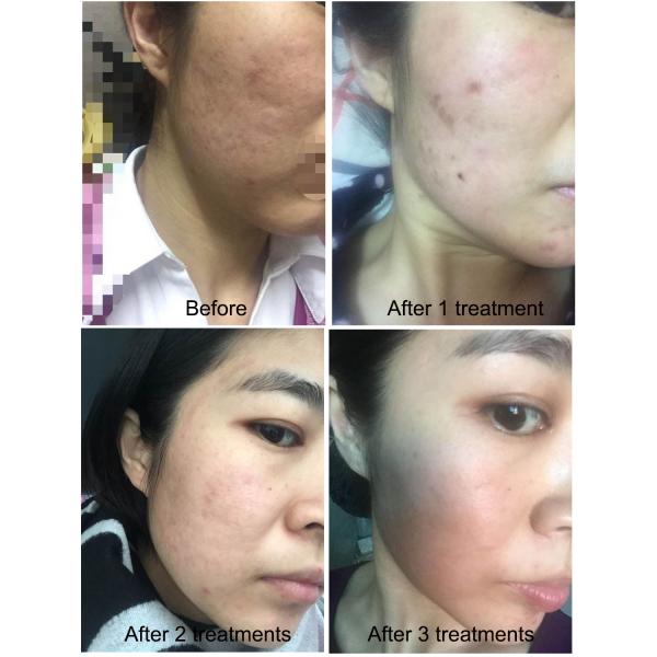 Fractional Radiofrequency Micro Needling Machine For Skin Rejuvenation 25/49/81 Pins 5MHZ