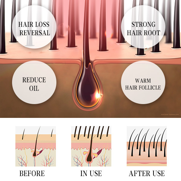 Clinique de coiffure et salon de coiffure Machine de repousse laser à bas niveau pour la perte de cheveux