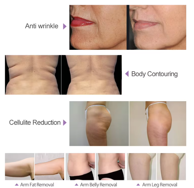 Vela Roller Vacuum RF Body Slimming Beauty Machine For Face Lifting Skin Tightening