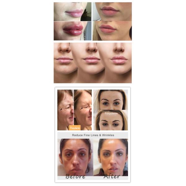 впрыска губы 1ml дермальных заполнителей 0.28mm HA Hyaluronic кисловочная