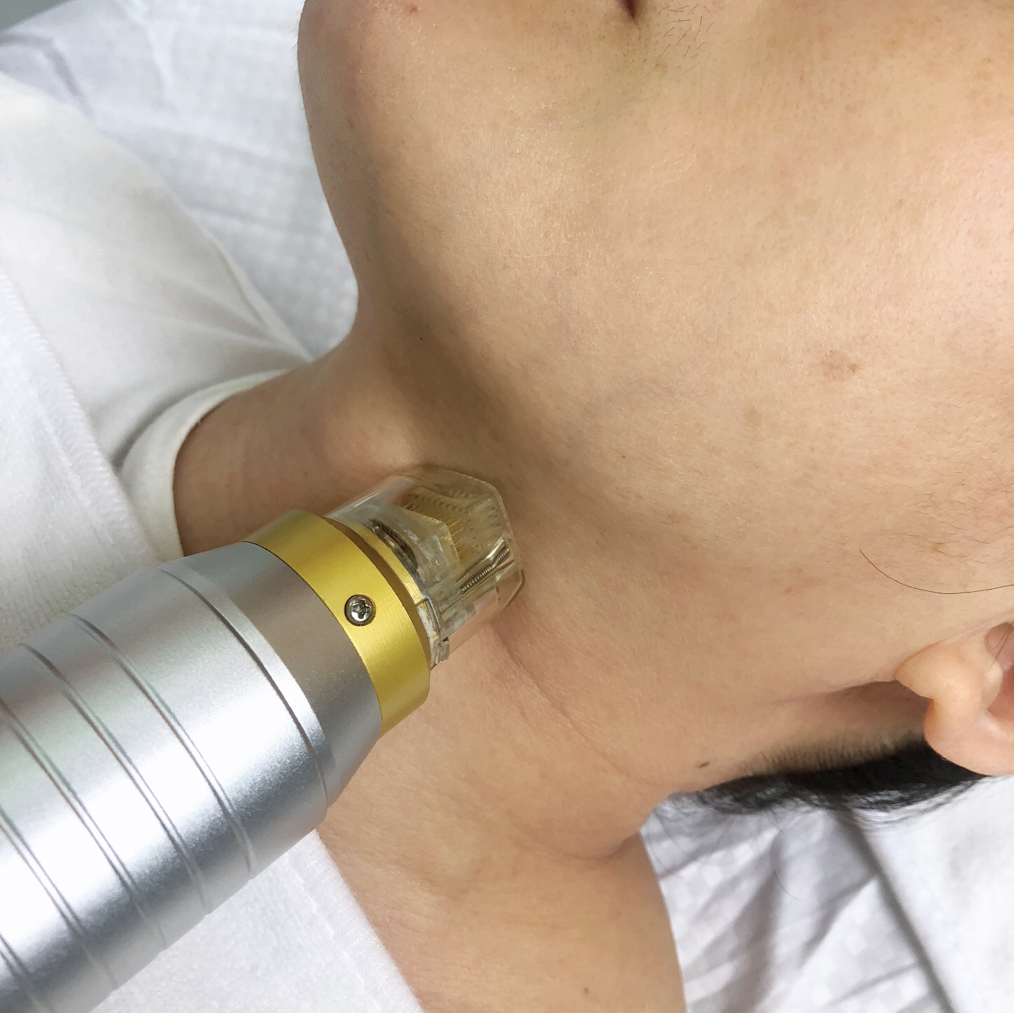 Кожа Resurfacing частичная машина RF Microneedle с холодной терапией инвазионной