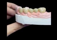 Toutes les couronnes et ponts en céramique sont conçus pour une esthétique supérieure, une durabilité et une adéquation naturelle pour une confiance durable.