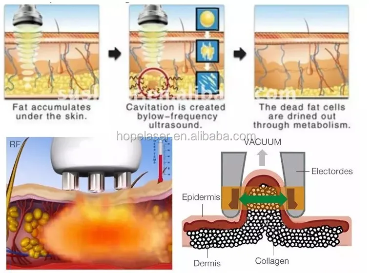 High quality 8 Pads Diode Lipo Laser LLLT Ultrasonic 40K Cavitation Slimming Vacuum RF Cellulite Weight Loss Machine