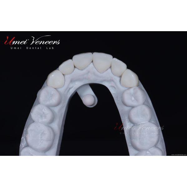 Natural White Cast Porcelain Veneers