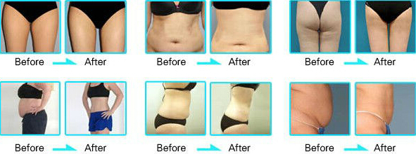 Quick Slim! Weight Loss Beauty Equipment RF Cavitation machine for sale