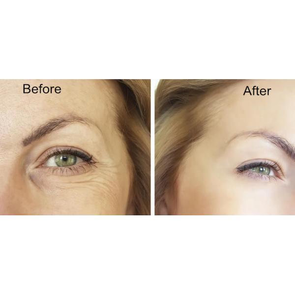 Точным форма соединенная крестом Skinject Hyaluronic кисловочная дермальная заполнителя геля 2ml