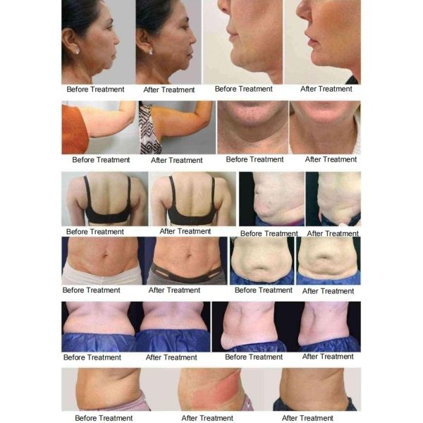 Trusculpt ID EMS Monopolar RF Body Slimming Beauty Machine For Fat Removal