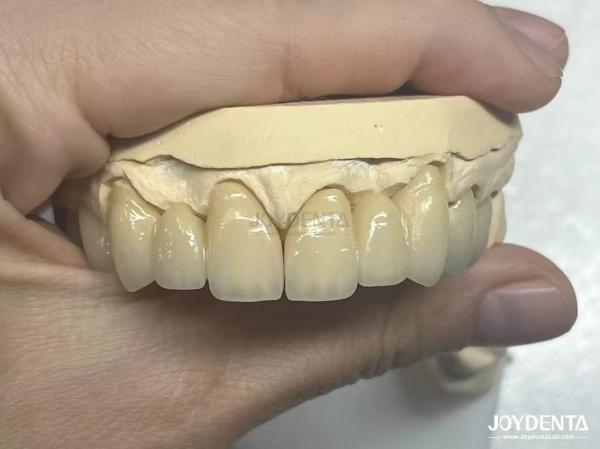 Seamless PFM Porcelain Fused Metal Crown For Long Term Biocompatible Restoration