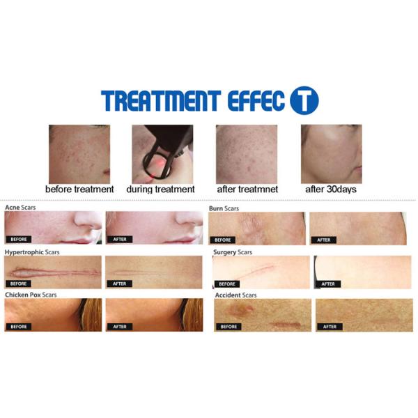 Medical equipment CO2 fractional laser stretch marks device price for aesthetic equipment