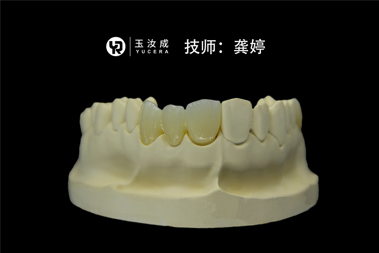 Система CAD CAM блока Zirconia Yucera 3D Pro разнослоистая для Anterior кроны