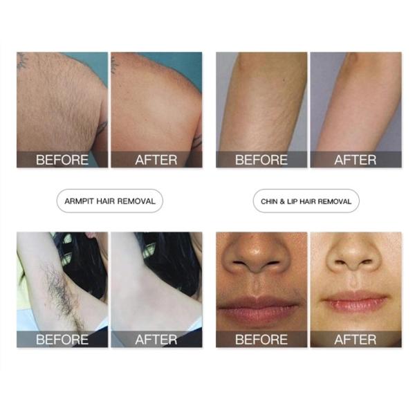Commercial Laser Hair Tattoo Removal Machine 2 In 1 Diode Laser 808nm + Yag Laser 5320nm 1064 Nm