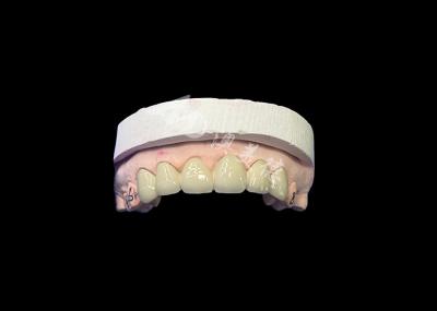 Biocompatible Porcelain Fused To Metal Crown High Durability For Enhanced Restoration