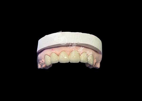 Porcelana biocompativel fundida em coroa de metal para melhor restauração