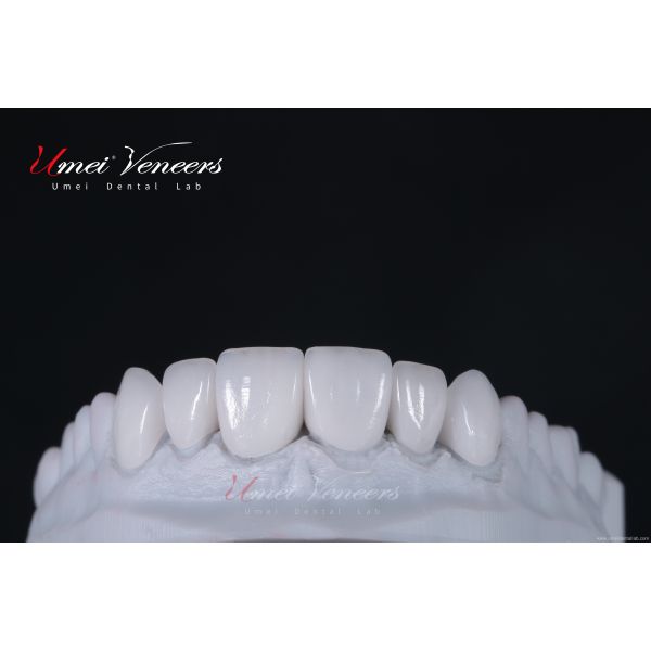 Natural White Cast Porcelain Veneers