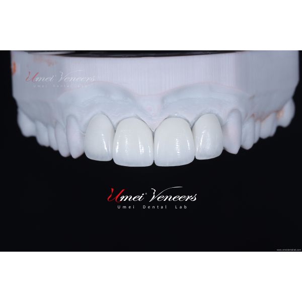 Customized ultra-thin dental veneer