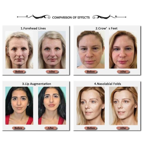 Jawline Filling Lip Juvederm Dermal Filler HA Инъекционные наполнители для лица