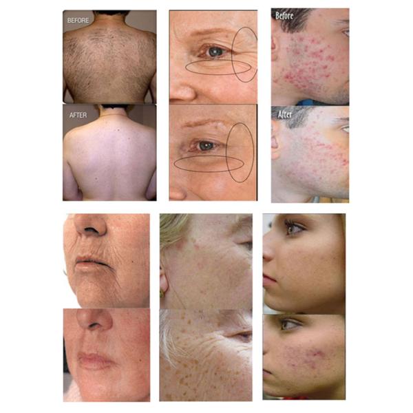 Newest design best shr laser hair removal equipment ipl device shr devices