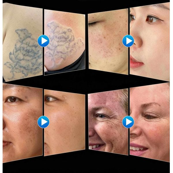 High Power Pico Laser Machine For Tattoo Removal / Melasma / Skin Rejuvenation