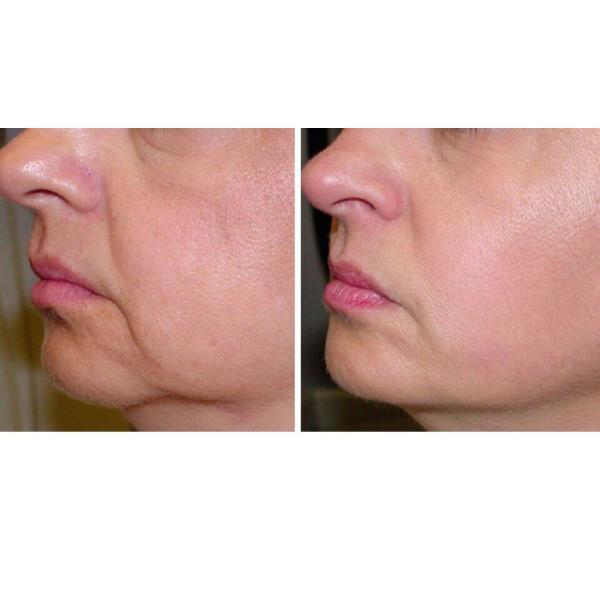 Pain Free Multi Function Laser 3 Handpiece , 808 Nm Hair Loss Laser Machine