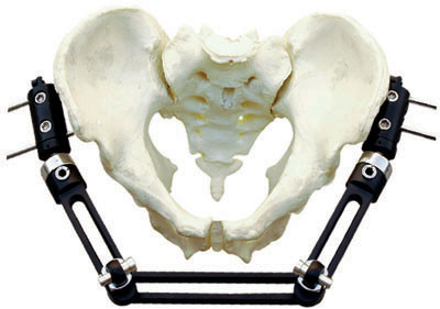 Pelvic Fracture Orthopedic External Fixator Implant Materials For Trauma Operation