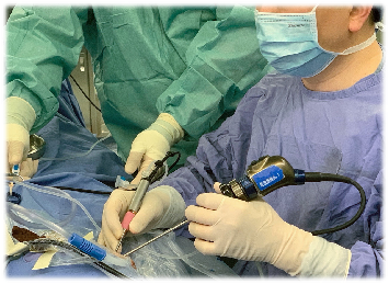 Sistema OTORRINOLARINGOLÓGICO e Debrider da broca do sistema do barbeador para o osso que mói o corte e dar forma