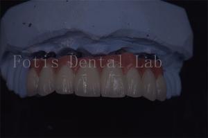 Precision Crafted Dental Implant Crowns For Superior Longevity And Comfort