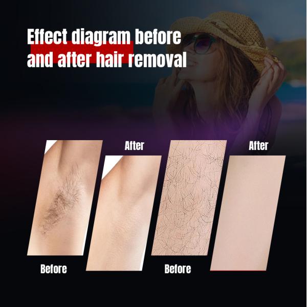 Long Pulse Hair Removal 755nm 1064nm Alexandrite Machine for Veins and Vessel Removal