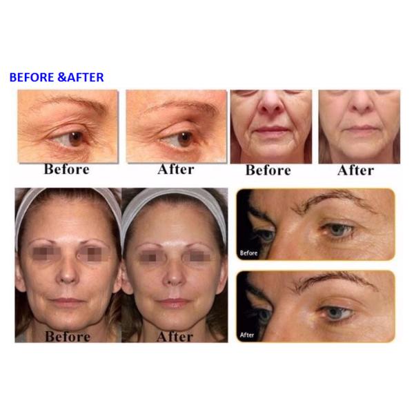 Meso Therapy Water Oxygen Jet Peel Machine Excellent Absorption Ability