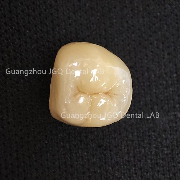 Porcelain Metal Crowns Fixed Denture Restorations Metal Pfm Custom China Dental Lab
