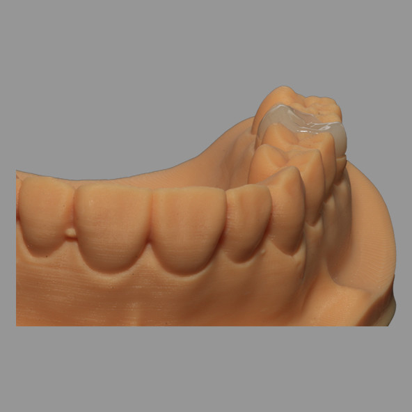 Full Ceramic Dental Emax Inlay Onlay Crown Pressed / Milled