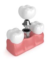 Dentaduras Verdadeiras Implantes Dentaduras Simples Todas De Cerâmica Recheios de Dentes Perdidos