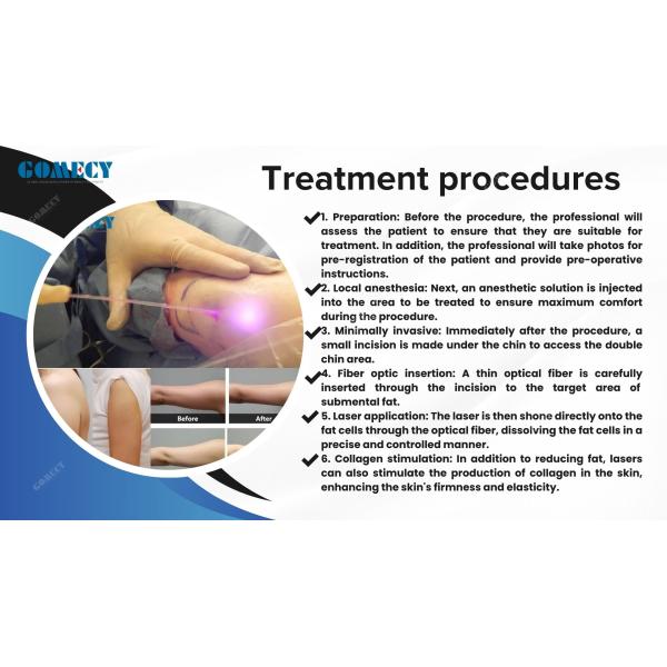 Endo Face Lifting Lipolysis Laser Liposuction Body Slimming Machine Diode 635 980 1470nm Endolaser Laser Equipment