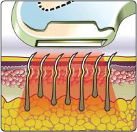 beauty spa equipment good result portable 12 month warranty IPL machine