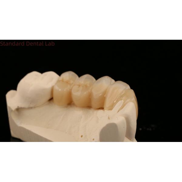Noritake Porcelian Full Contour Zirconia Crown High Aesthetic Natural Customized Zirconia Dental Bridge