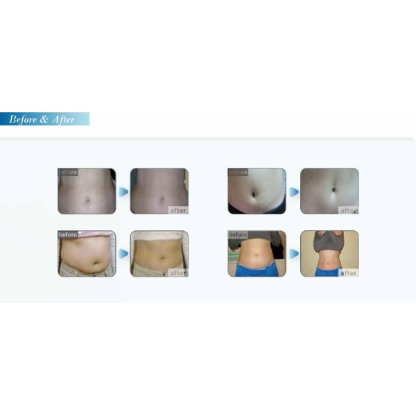 perfect cooling 5 handles cryolipolysis machine for sale/cryolipolysis shaping machine