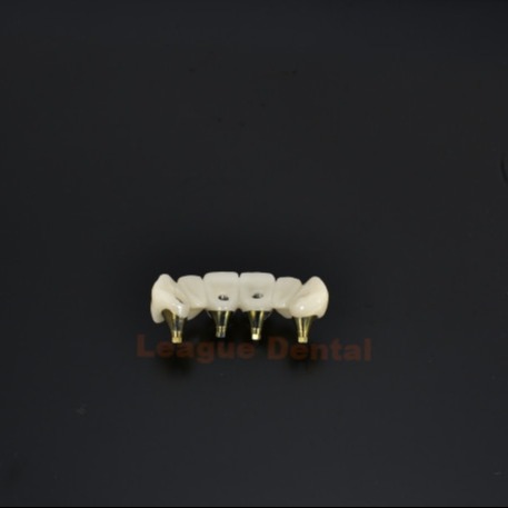 Strength And Precision Titanium Custom Abutment Implant Restorations