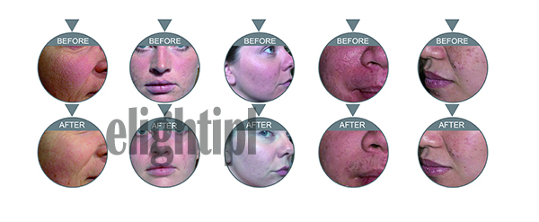 Hydro Dermabrasion Water Oxygen Jet Peel Machine Acne Treatment CE Approved