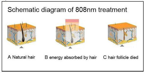 10*12m m 10 equipo permanente del retiro del pelo de las barras 2000W